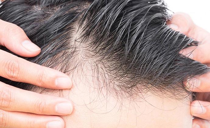 جلوگیری از ریزش مو